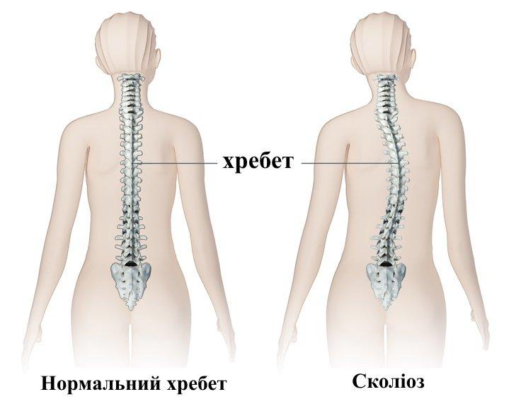 сколіоз